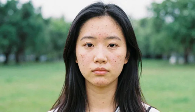 非手术美容项目：皮肤健康问题如何应对